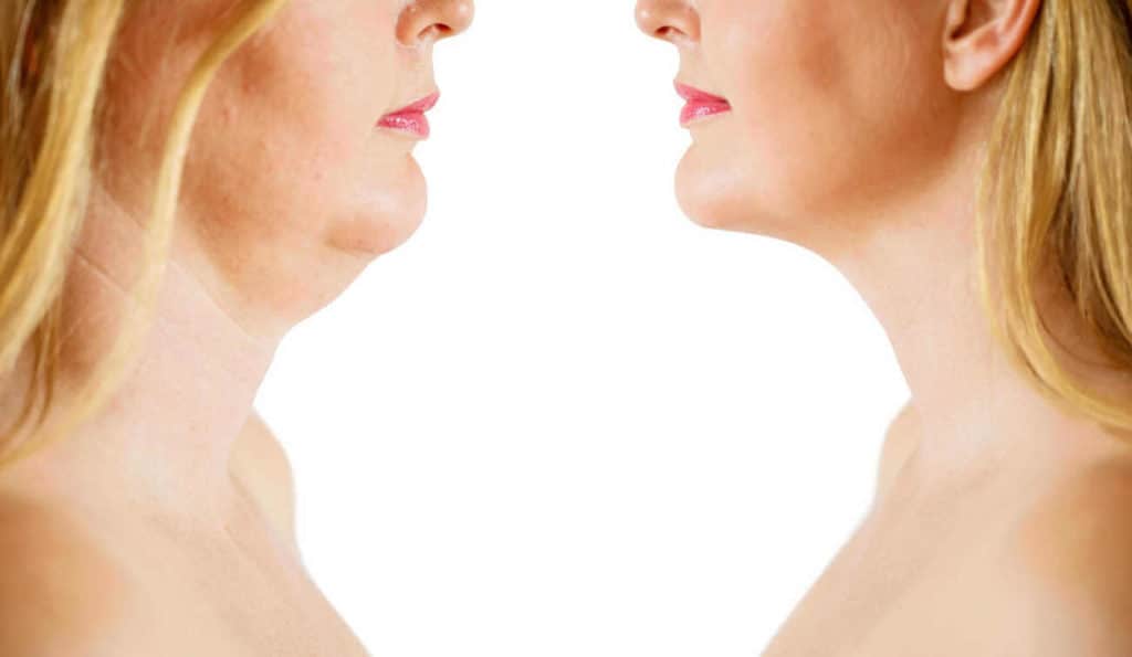 Double Chin treatment Kensington before and after results
