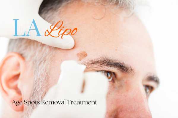 What Are the Most Effective Treatments for Age Spots Kensington?