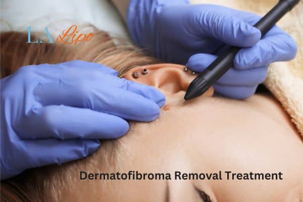 Dermatofibroma Removal Treatment Kensington