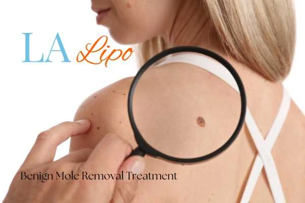 Woman having her inspection of blemish before mole removal Kensington