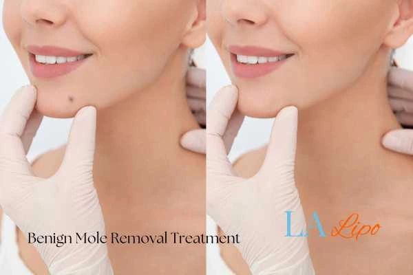woman's before and after mole removal Kensington results