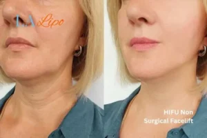 hi-fu for wrinkles Kensington before and after results