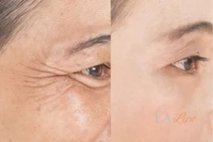 Before and after results of woman - HI-fu wrinkles reduction treatment Kensington