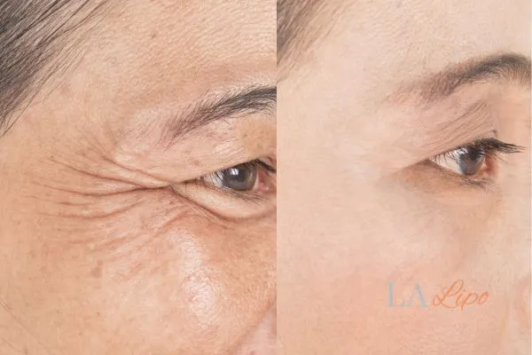 Before and after results of woman - HI-fu wrinkles reduction treatment Kensington