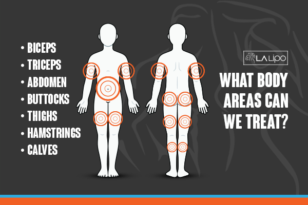 Graphic to show areas you can have LA-EMS Body Sculpting Kensington treatment.