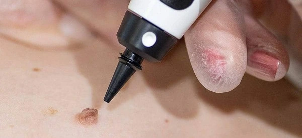 skin tag removal using cryopen Kensington