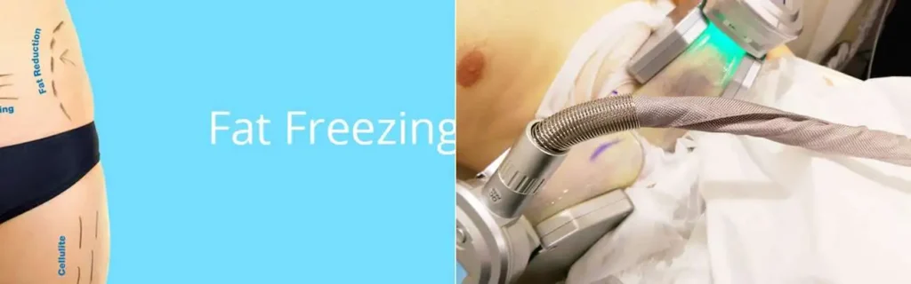Fat freezing Kensington on multiple areas of the body