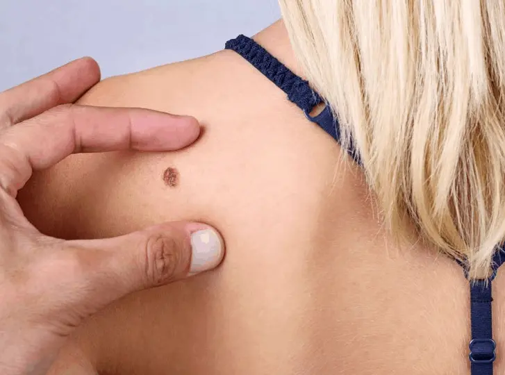 woman having mole removal Kensington consultation before treatment.
