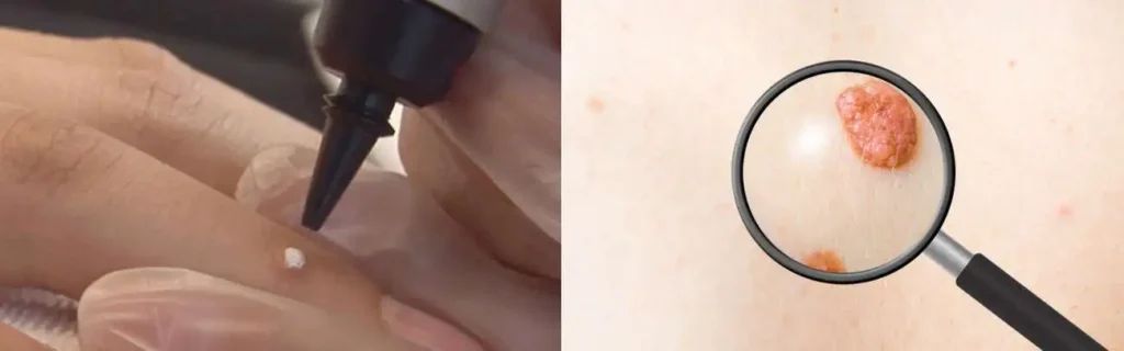 Cryopen for mole removal Kensington - speak to our team today!