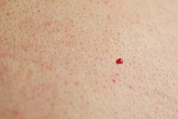 close up of a cherry angioma Kensington