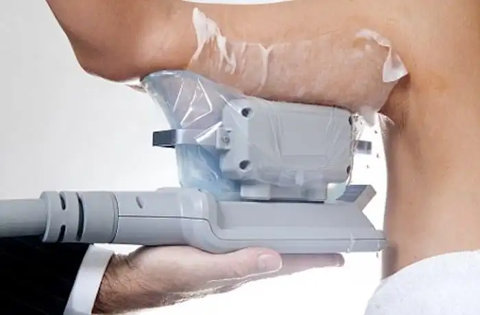 Picture of fat freezing Kensington on the upper arms.