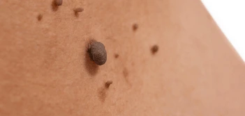 image of a skin tag Kensington