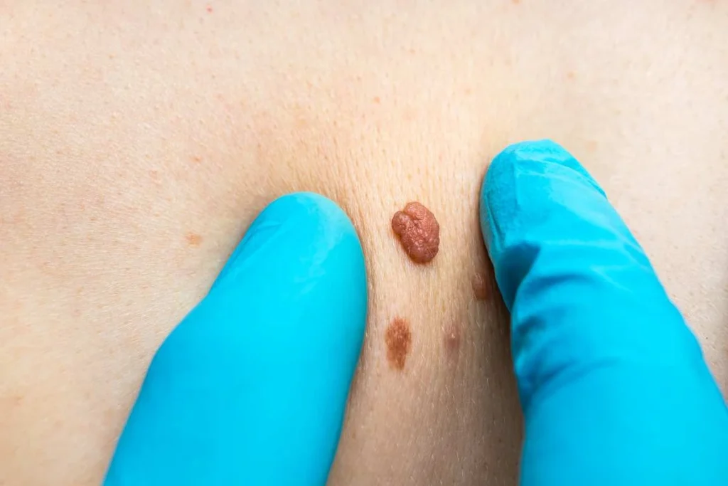 Consultant examining a skin tag Kensington