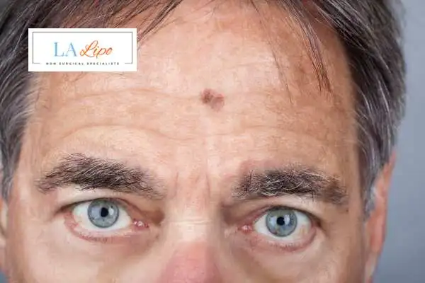 Solar Lentigo Removal Kensington image of man with mark on his forehead
