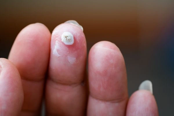 wart on person finger - cryotherapy to treat from LA LIPO Kensington
