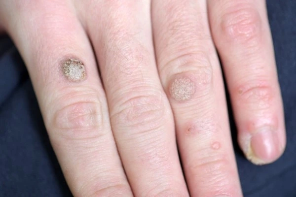 photo of warts on person hand - see wart removal Kensington from LA LIPO