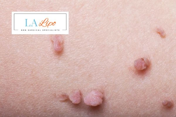 Does cryopen skin tag removal Kensington hurt? Find out now call our team today!