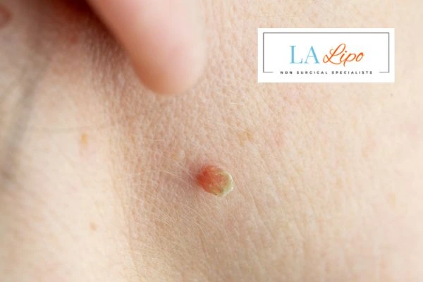 Book skin tag removal Kensington today speak to our team now!