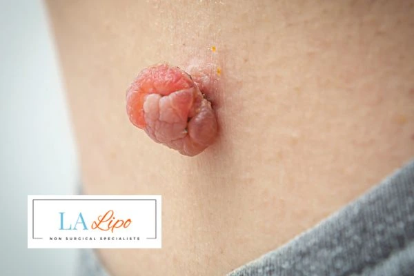 Interested in skin tag removal Kensington? Concerned about the pain? Find out more today!