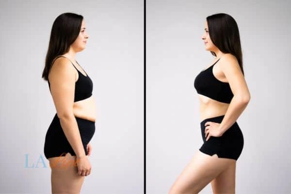 Picture of womans before and after using LA-EMS body sculpting to improve her core strength Kensington