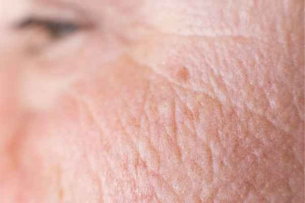 close up picture of a woman's face showing an age spot Kensington