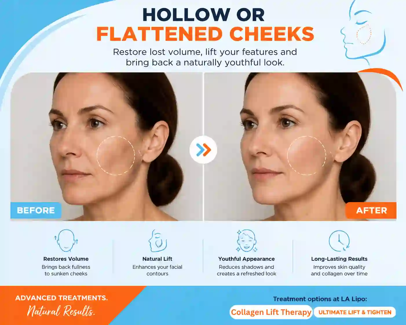 Sign #4: Hollow or Flattened Cheeks Kensington