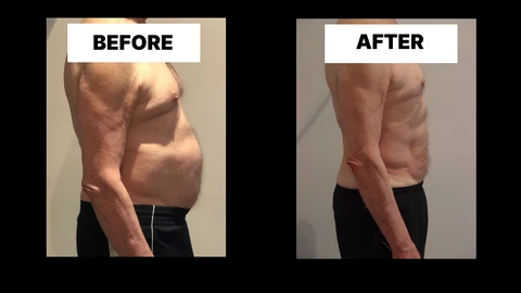 What Symptoms Can Diastasis Recti Cause in Men? Weak Core, Back Pain and Poor Posture Kensington